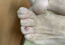 腳指甲長纖維瘤 樂生醫院長曝是1罕見遺傳疾病