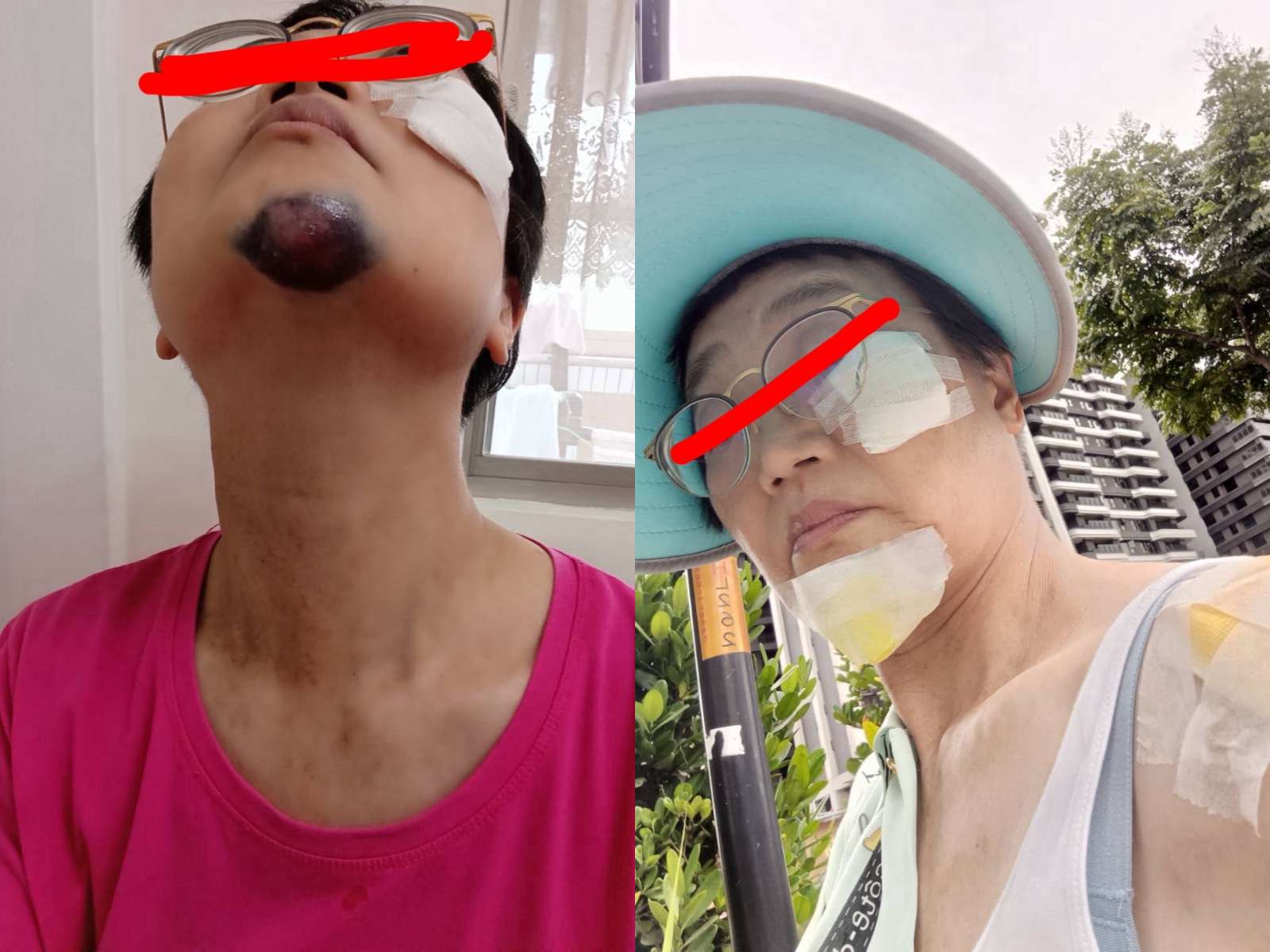 婦參加活動慘摔鼻青臉腫 承包廠商遭質疑態度惡劣