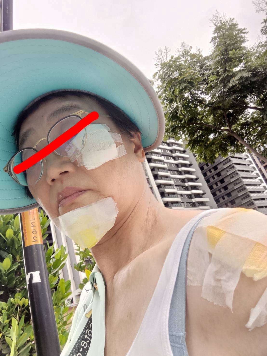 婦參加活動慘摔鼻青臉腫 承包廠商遭質疑態度惡劣 S 64479255 0