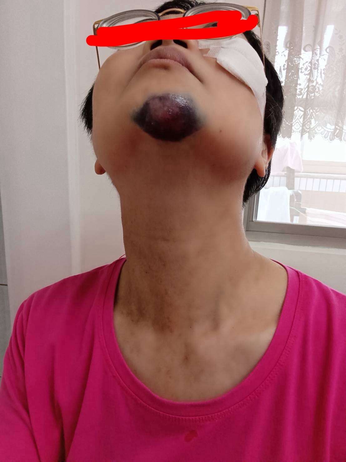 婦參加活動慘摔鼻青臉腫 承包廠商遭質疑態度惡劣 S 64479257 0
