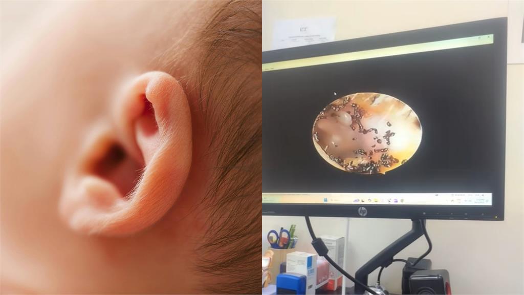 耳朵痛看醫生竟爆「蟲蟲危機」超噁畫面曝