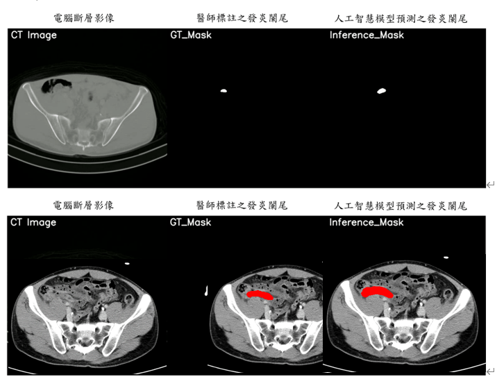 圖三元智電機系攜手亞東影像醫學科團隊，使用電腦斷層掃描影像，進行判別是否發生急