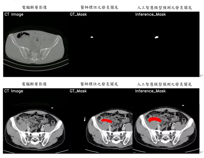 圖三元智電機系攜手亞東影像醫學科團隊，使用電腦斷層掃描影像，進行判別是否發生急
