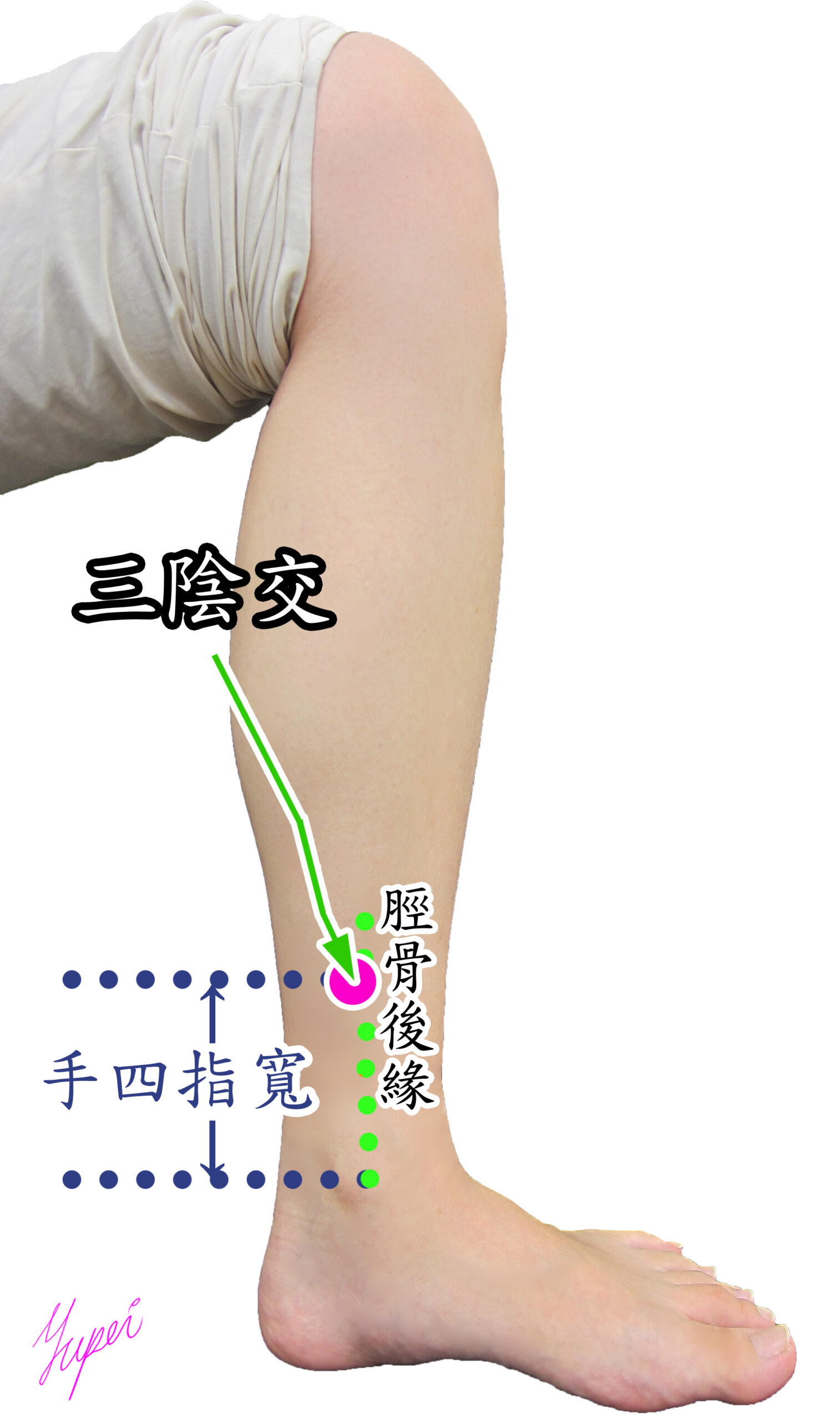 恩主公醫靠這招緩解化療副作用 陪伴病患抗癌 緩解癌症化療造成的手腳麻症狀的針灸穴位三陰交 scaled