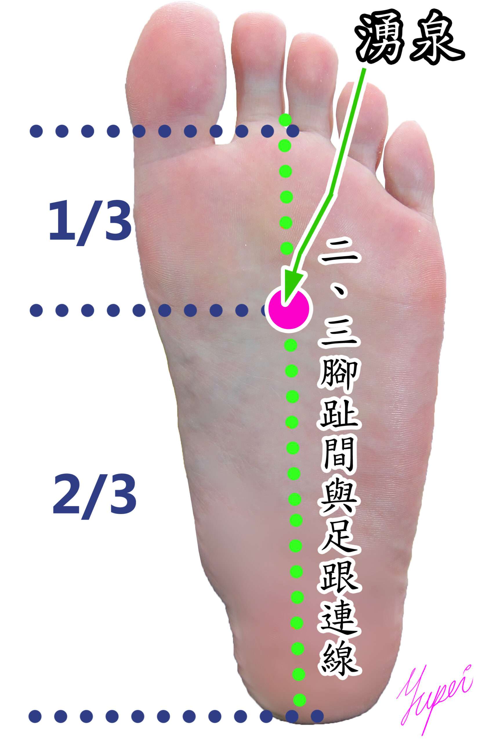恩主公醫靠這招緩解化療副作用 陪伴病患抗癌 緩解癌症化療造成的手腳麻症狀的針灸穴位湧泉 scaled
