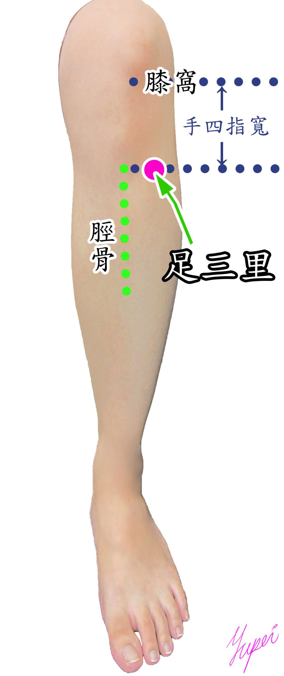 恩主公醫靠這招緩解化療副作用 陪伴病患抗癌 緩解癌症化療造成的手腳麻症狀的針灸穴位足三里 scaled