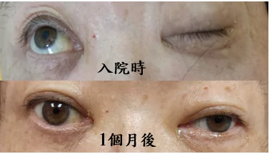 不是中風!眼睛張不開 北榮桃園分院診斷是這疾病導致 fwg5tf