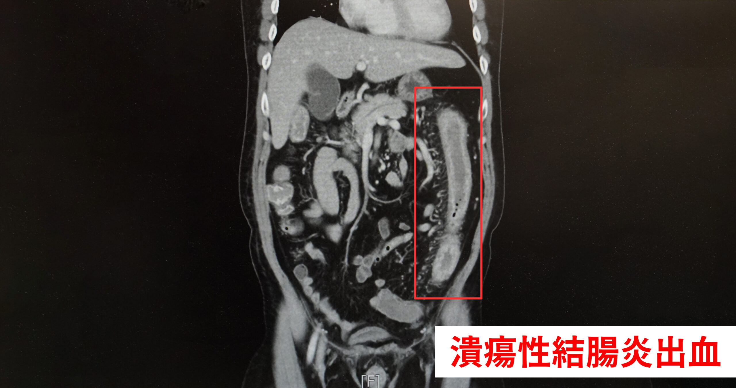 他患潰瘍性結腸炎險喪命 中醫大新竹附醫曝只因做了這事 結腸炎出血 scaled
