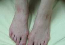 桃園首例本土麻疹現蹤!衛生局提醒去過「這地方」要注意