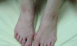 桃園首例本土麻疹現蹤！衛生局提醒去過「這地方」要注意