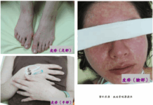 麻疹疫情升溫!清明連假慎防境外移入感染風險