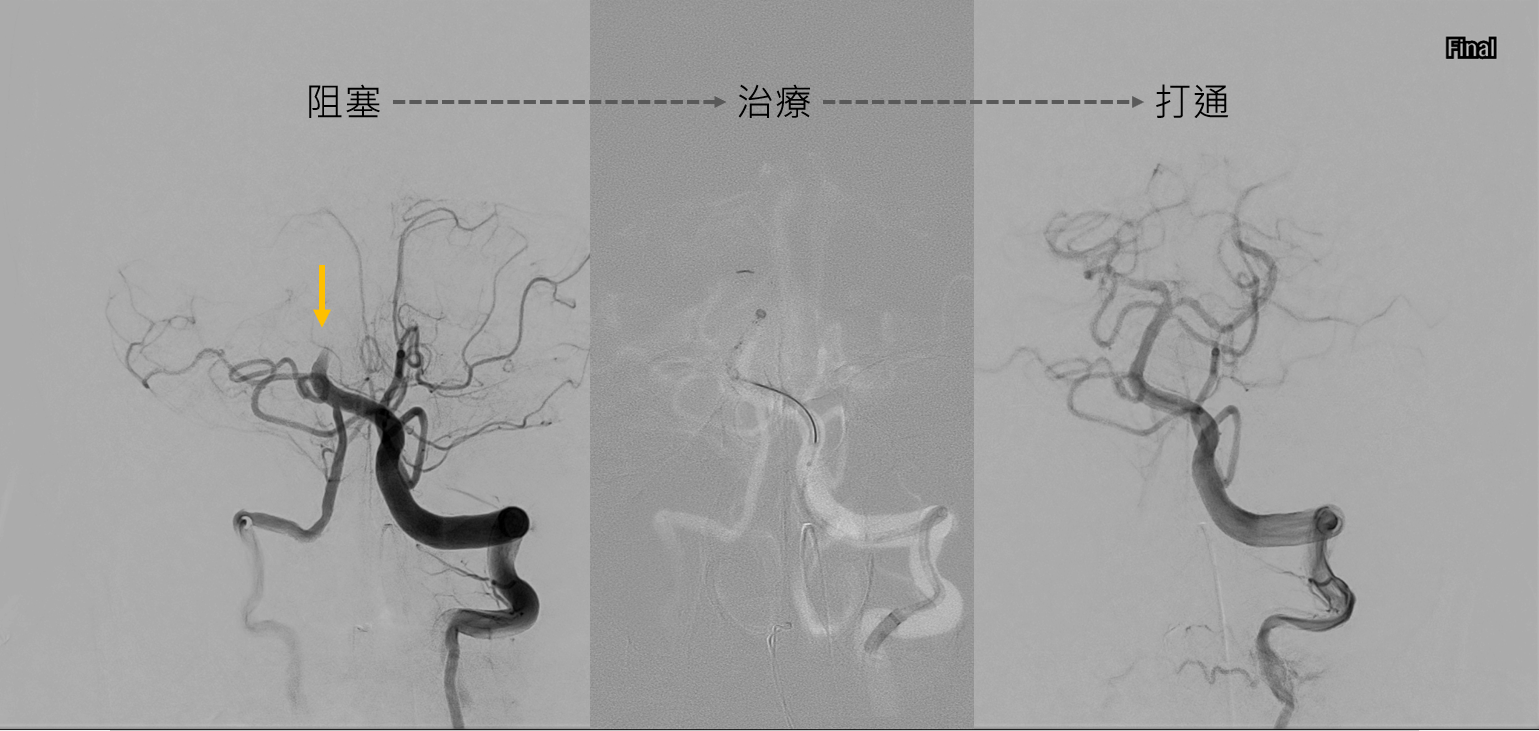「沒有臉歪無力」竟確診腦中風!聯新國際醫:少見但情況危急 03基底動脈阻塞到打通 0