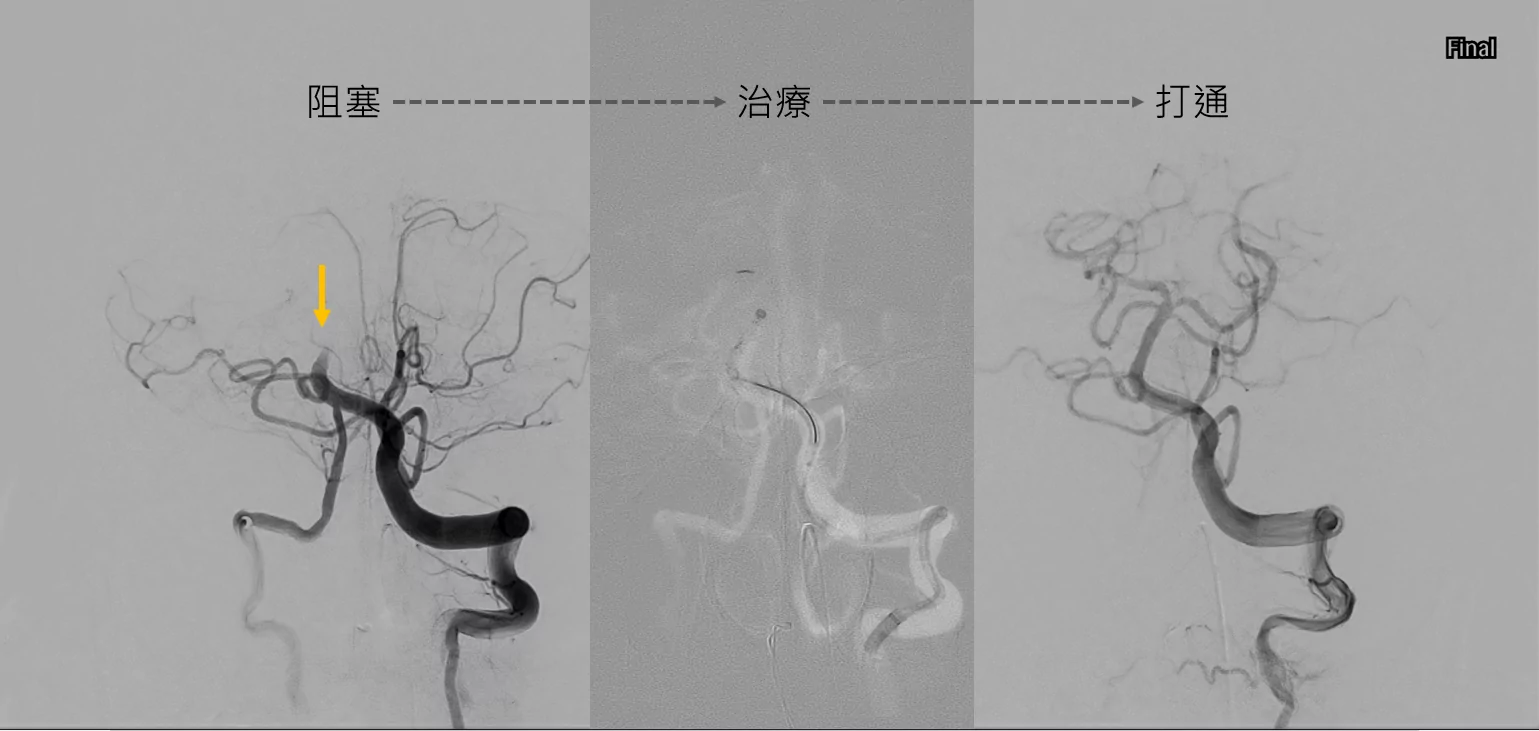 「沒有臉歪無力」竟確診腦中風!聯新國際醫:少見但情況危急 03基底動脈阻塞到打通 0