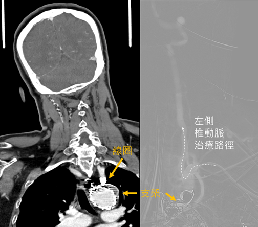 「沒有臉歪無力」竟確診腦中風!聯新國際醫:少見但情況危急 04主動脈支架阻擋取圈路線 0