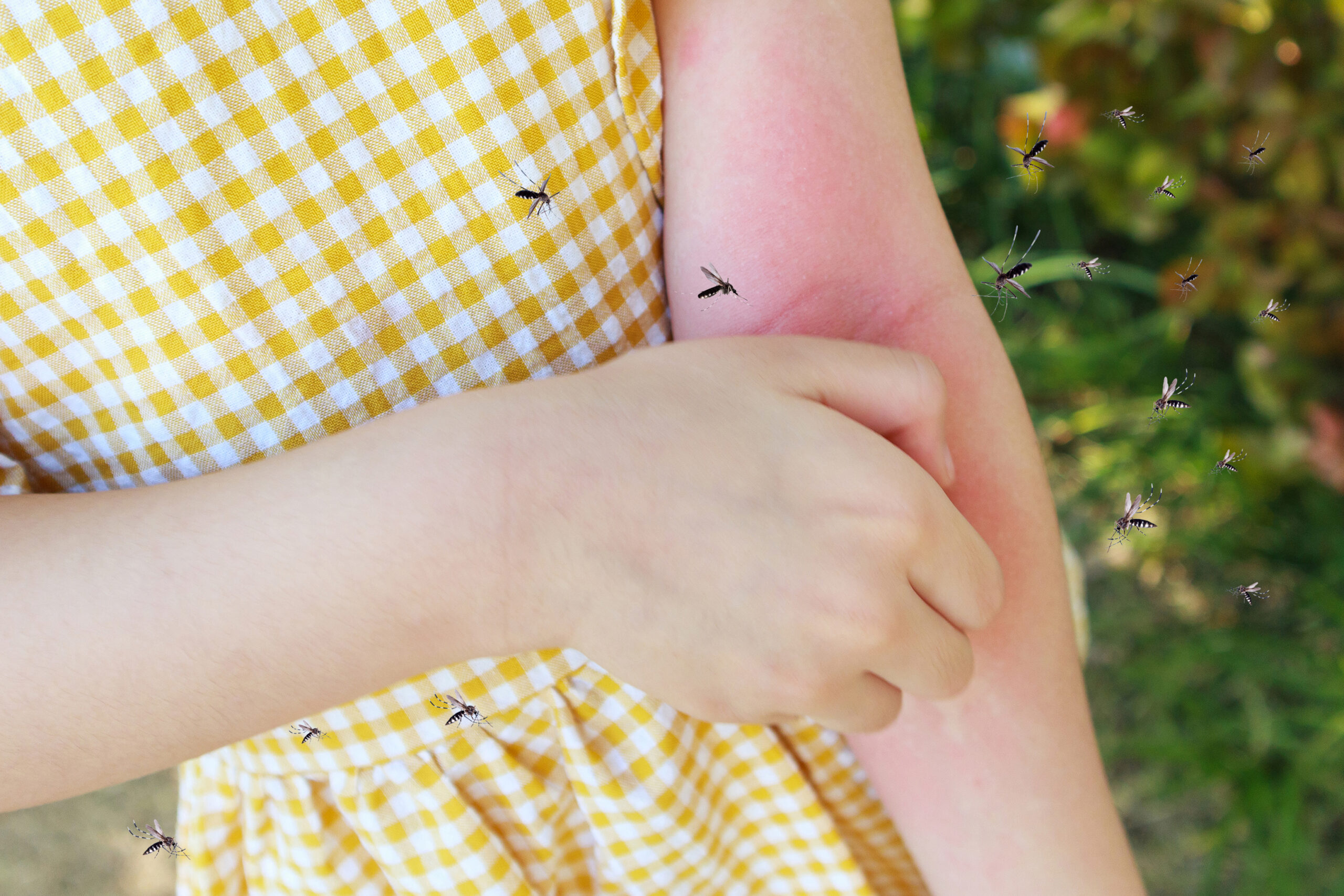 登革熱與屈公病境外移入雙升溫 疾管署籲落實防蚊與通報 little girl has skin rash allergy itchy her arm from mosquito bite scaled