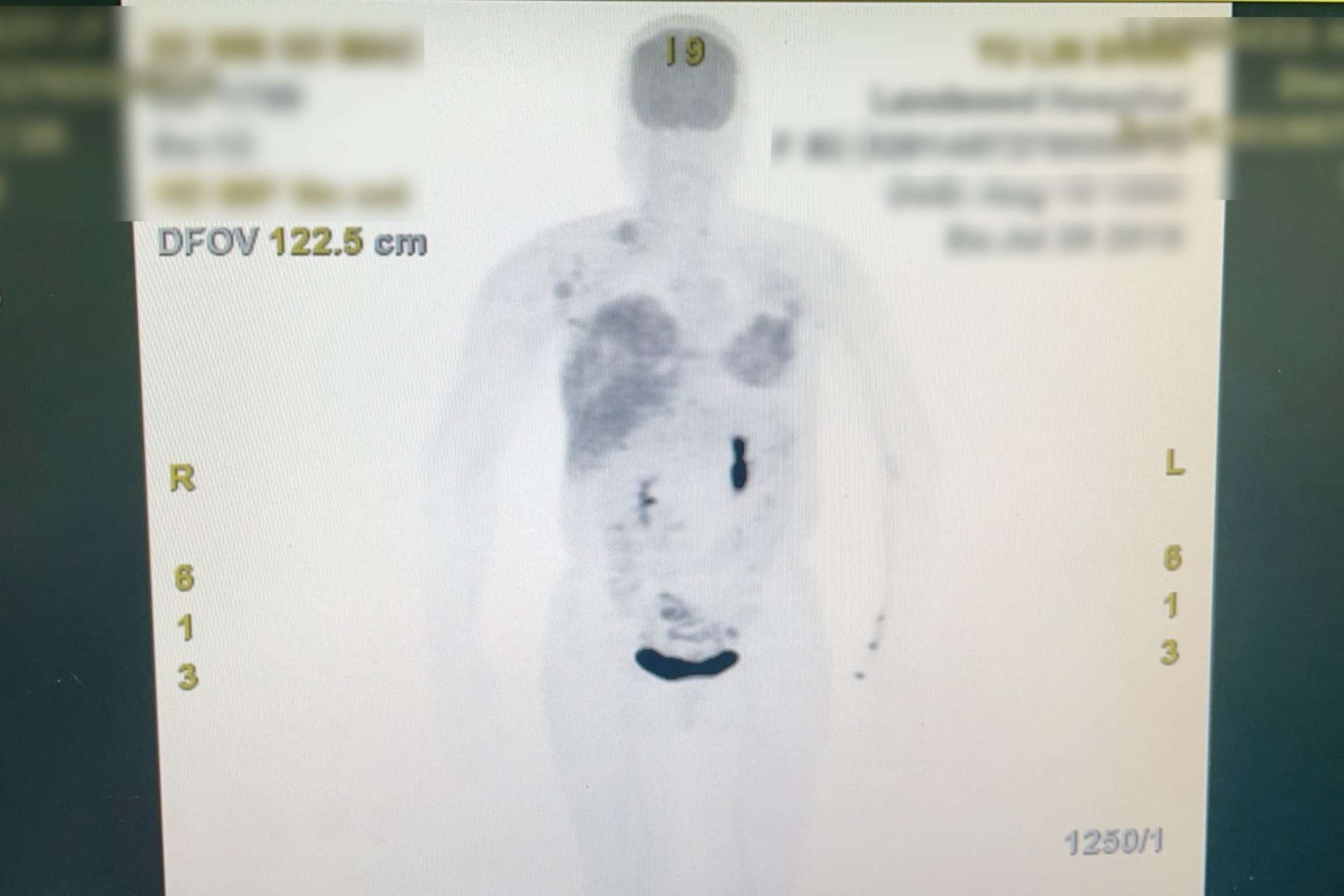 別因「腫瘤小」輕忽!聯新國際醫籲接受全面治療 降低乳癌復發率 正子攝影檢查照1 0