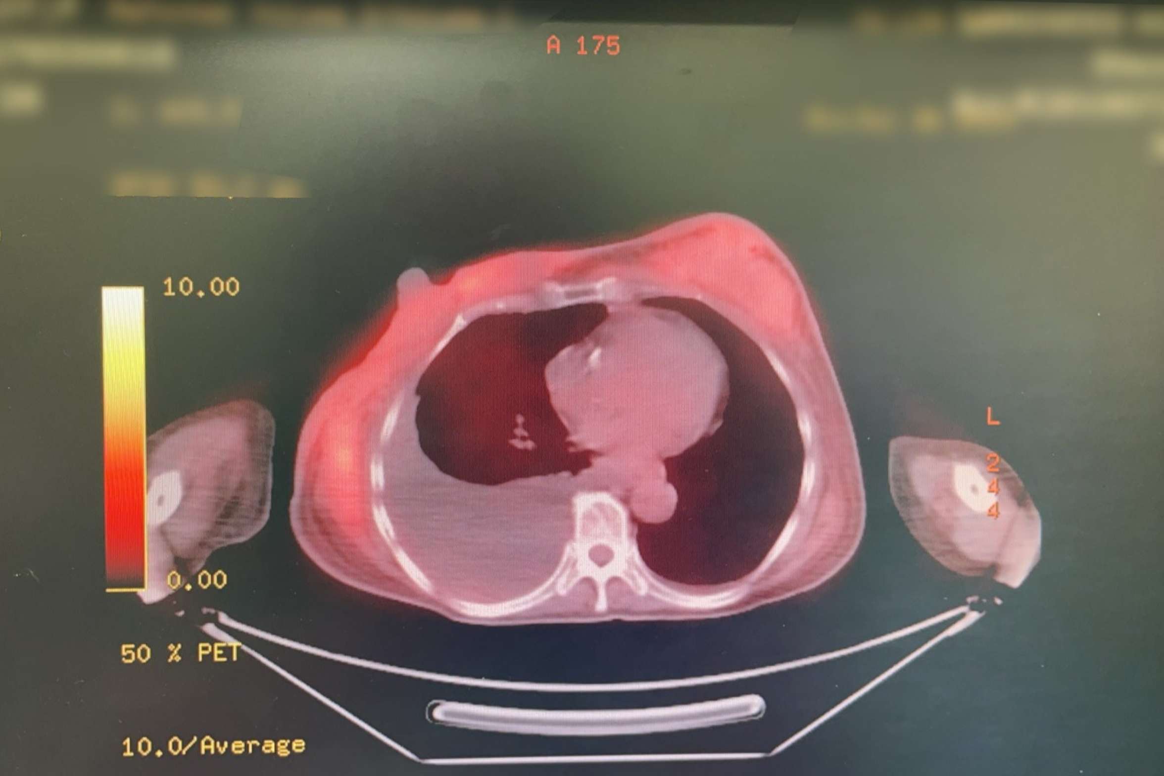 別因「腫瘤小」輕忽!聯新國際醫籲接受全面治療 降低乳癌復發率 正子攝影檢查照2 0