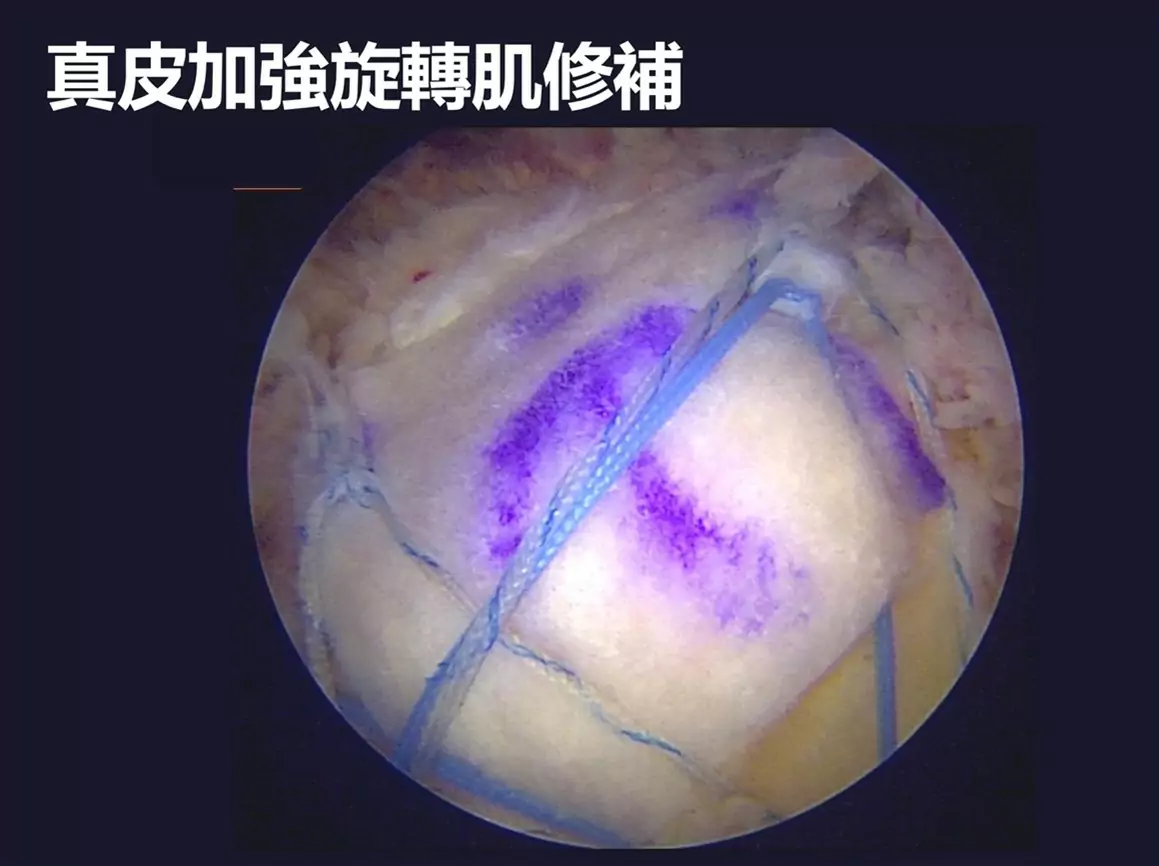 長期搬重物導致旋轉肌破裂 聯新國際醫籲把握黃金治療期 郭亮增醫師 2 0