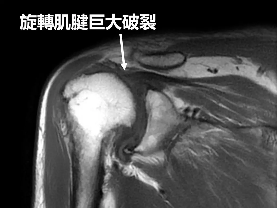 長期搬重物導致旋轉肌破裂 聯新國際醫籲把握黃金治療期 郭亮增醫師 3 0