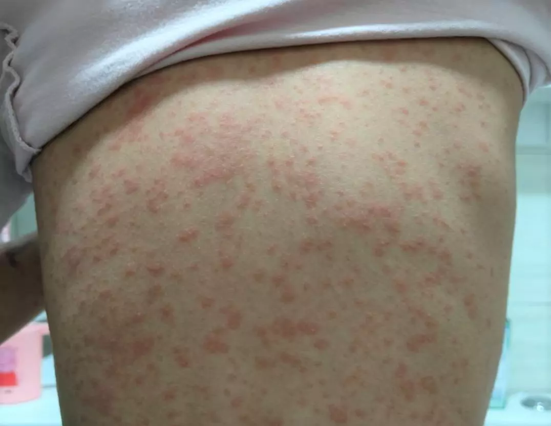 癢!女童喉嚨痛吃藥竟狂冒紅疹 部桃:這病毒在作祟 癢!女童喉嚨痛吃藥竟狂冒紅疹 部桃:這病毒在作祟