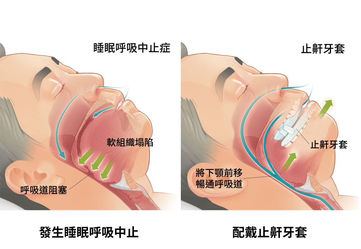 更年期失眠竟是「呼吸中止症」!醫籲:及早檢查治療! S 62046232 0