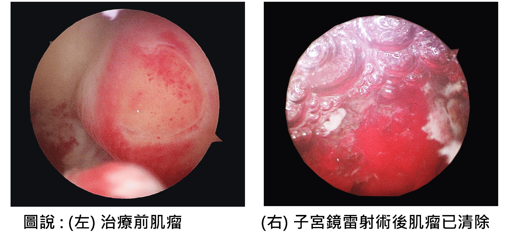 03肌瘤手術前後對比照 0
