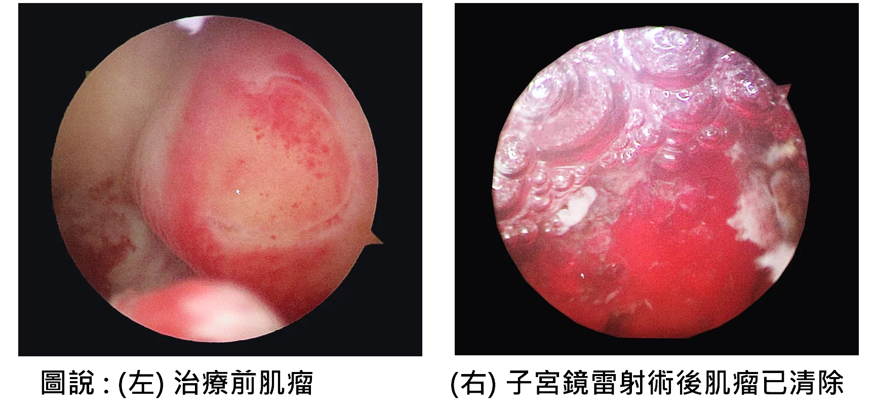 03肌瘤手術前後對比照 0
