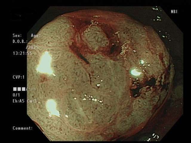 1照片 乙狀結腸惡性腫瘤 0