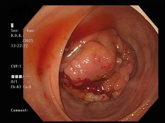2照片 乙狀結腸惡性腫瘤 0