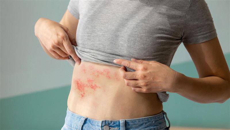 「皮蛇」病例攀升!專家曝這樣預防最有效