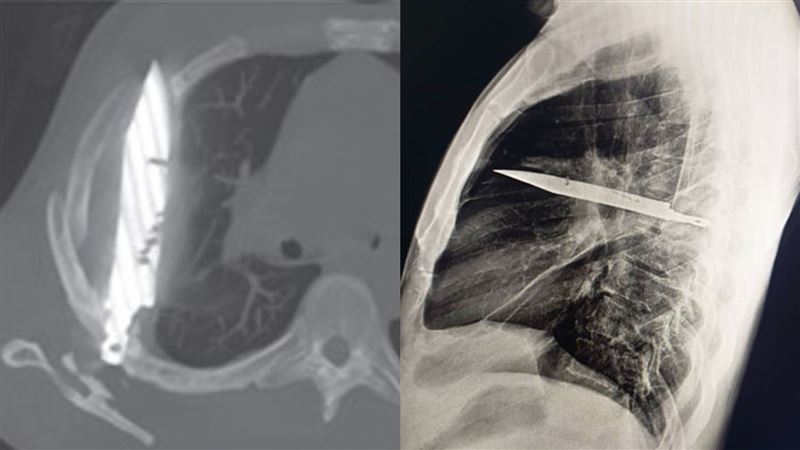 44歲男乳頭流膿 就醫竟發現體內「插著一把刀」