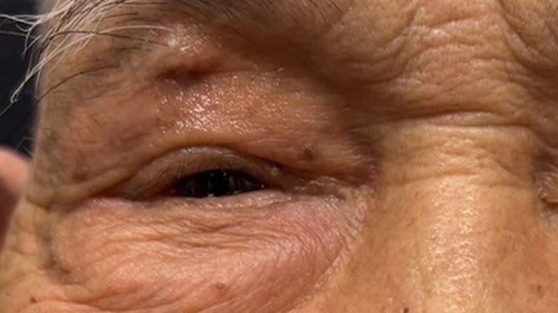 急性鼻竇炎竟影響視力 醫師曝原因