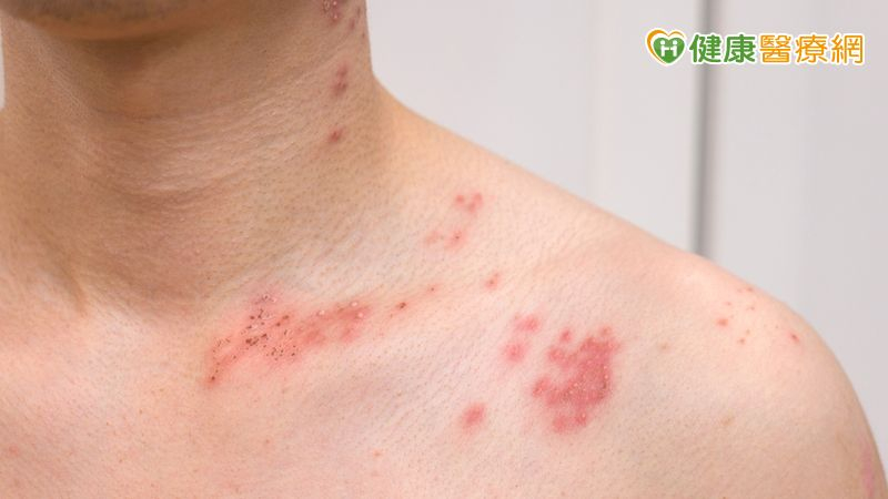 男側腹痛掛泌尿科無異常 三天後出紅疹痛到難眠才知「皮蛇」上身