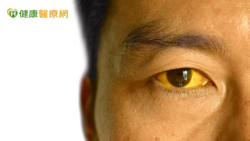 75歲退休教授突全身發黃! 竟是B肝急性肝衰竭險喪命