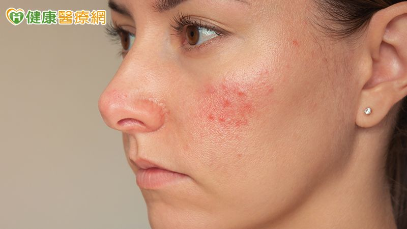 喝酒會加重酒糟鼻的症狀嗎?