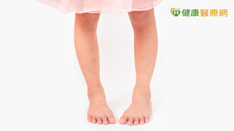 小孩腳內八要治嗎?復健醫提醒觀察「2狀況」應就醫