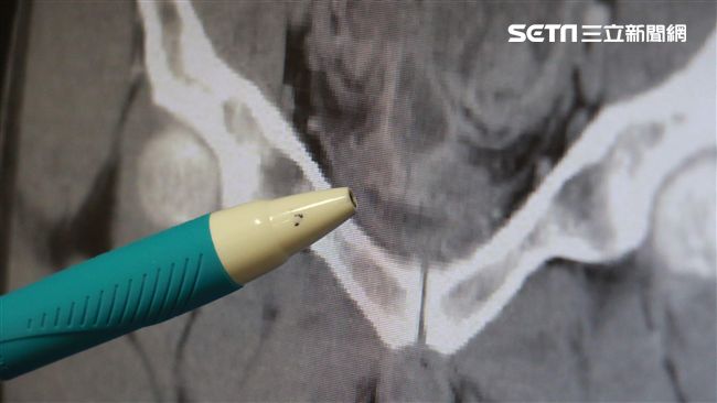 6旬婦出現無痛血尿竟是癌症 醫:症狀不明顯勿輕忽