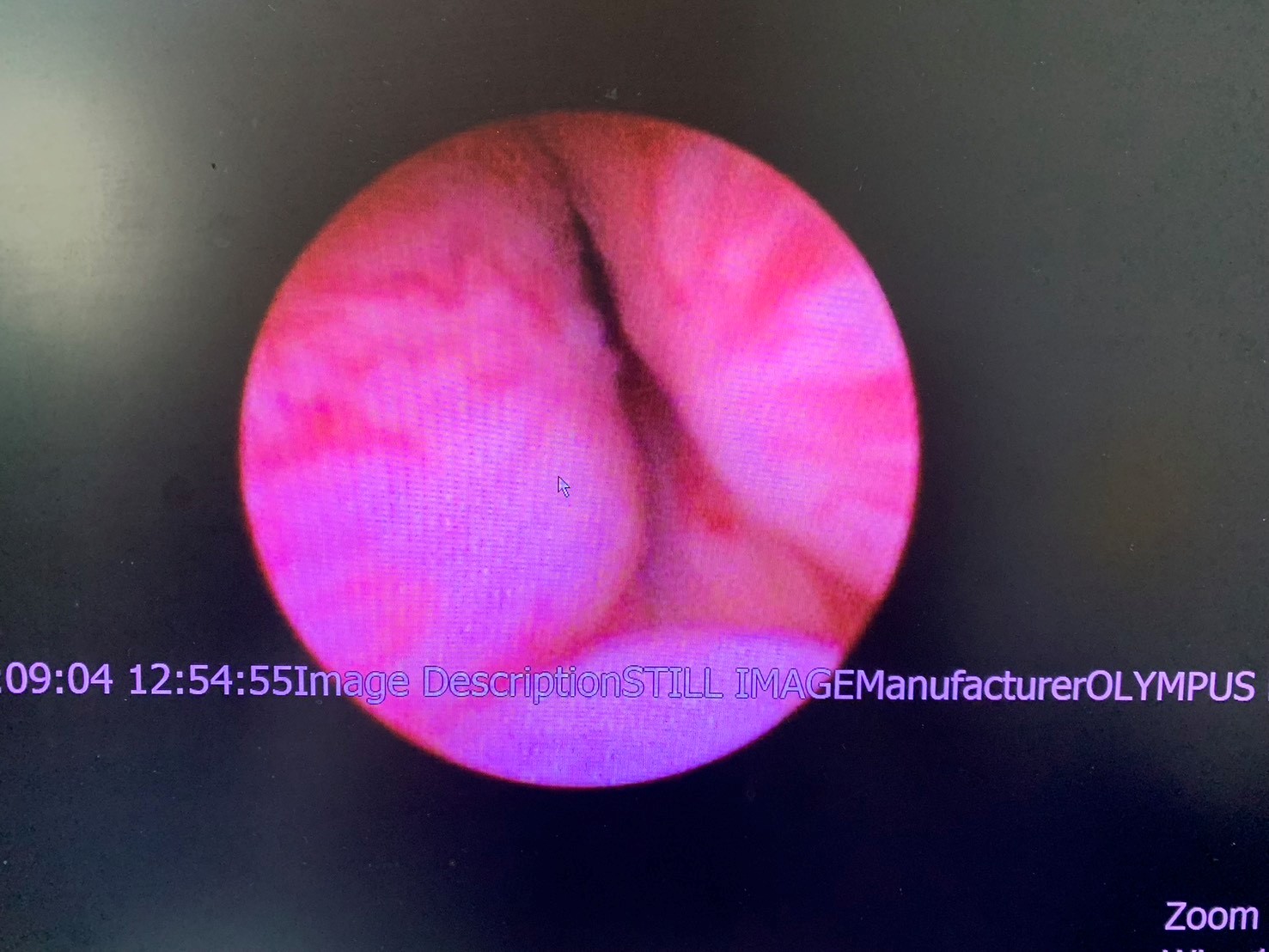 擺脫尿不乾淨困擾!北榮桃分院1招助患者恢復順暢人生 19