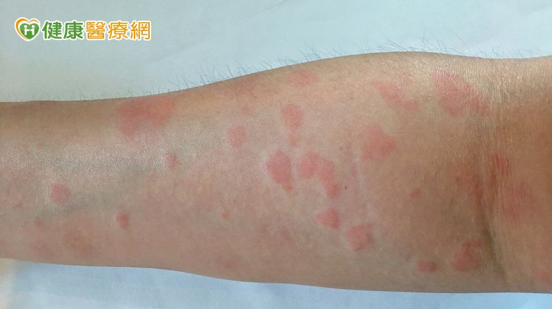 全身性紅斑性狼瘡病因複雜 生物製劑提升治療精準度