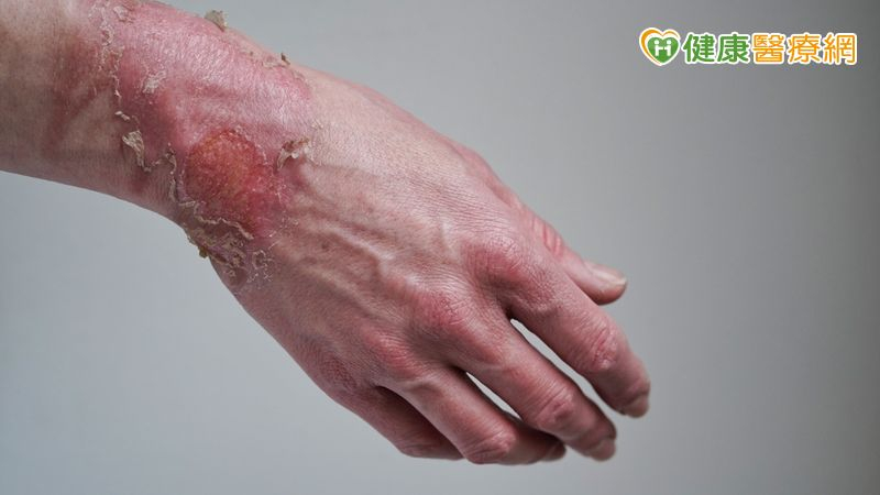 國際研究:燒燙傷後11天內植皮 減少併發症風險、總住院時間