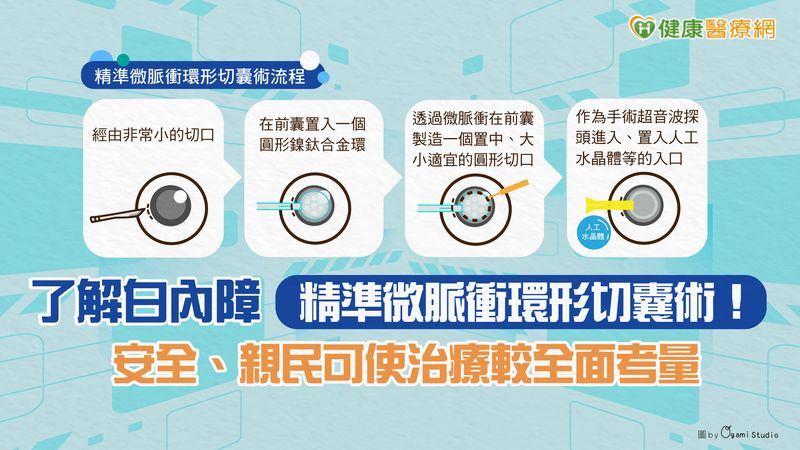 了解白內障「精準微脈衝環形切囊術」! 安全、親民可使治療較全面考量