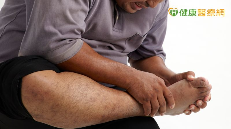 「腳腫如球」痛風如何治?基因檢測助攻 精準用藥更安心