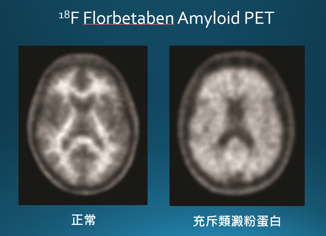 正子對比照 0