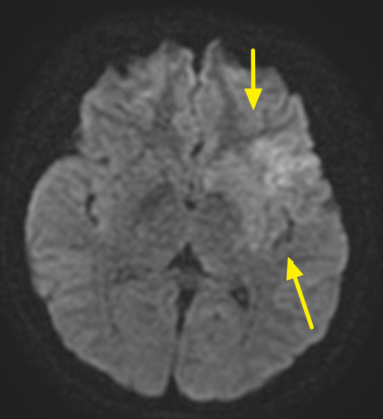 14歲學生突倒地竟是「腦中風」 聯新國際醫院把握黃金時間救命 核磁共振影像,箭頭處呈現早期缺血變化 0