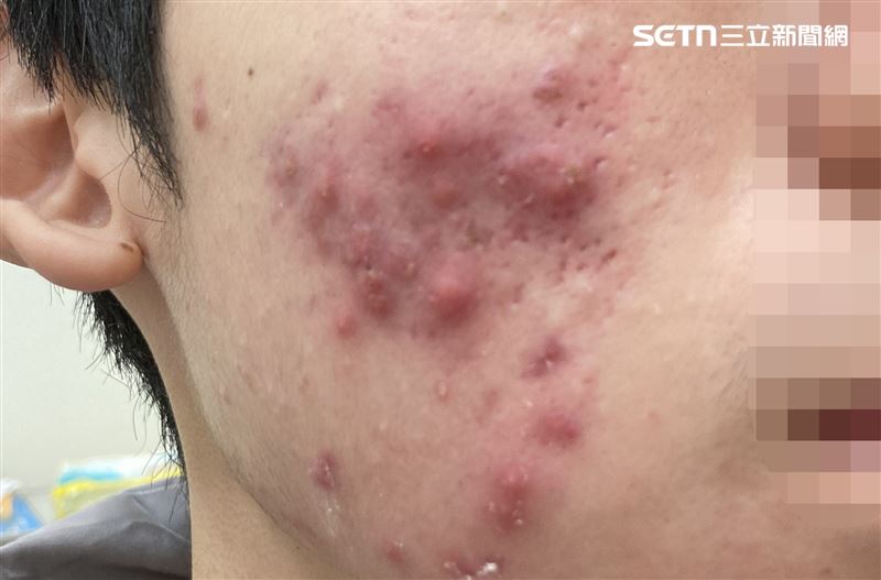 壓力大狂嗑炸物、手搖飲 考生滿臉爛痘「沒臉出門」