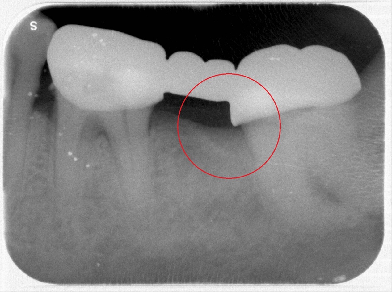 牙周炎別拖延就醫!北榮桃園分院:去除病因、定期回診很重要