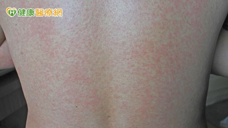 紅斑性狼瘡冬季容易惡化?中醫師提醒 飲食與循環調理重點