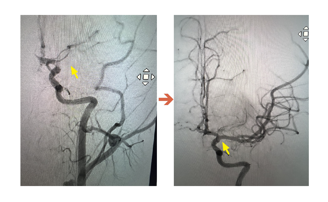 ICA血管攝影阻塞到打通 0