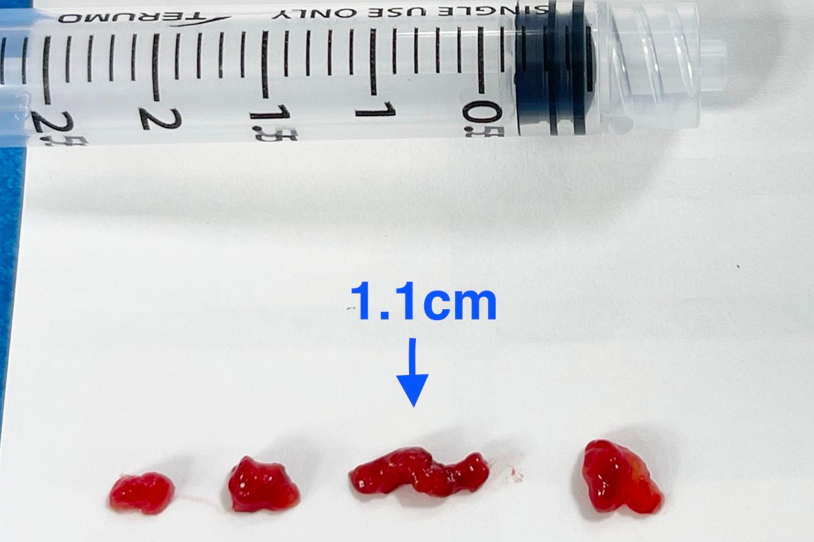 心臟黏液瘤血栓 0