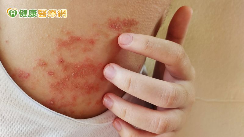 癢到睡不著、抓到流血?醫曝異位性皮膚炎3大關鍵解方
